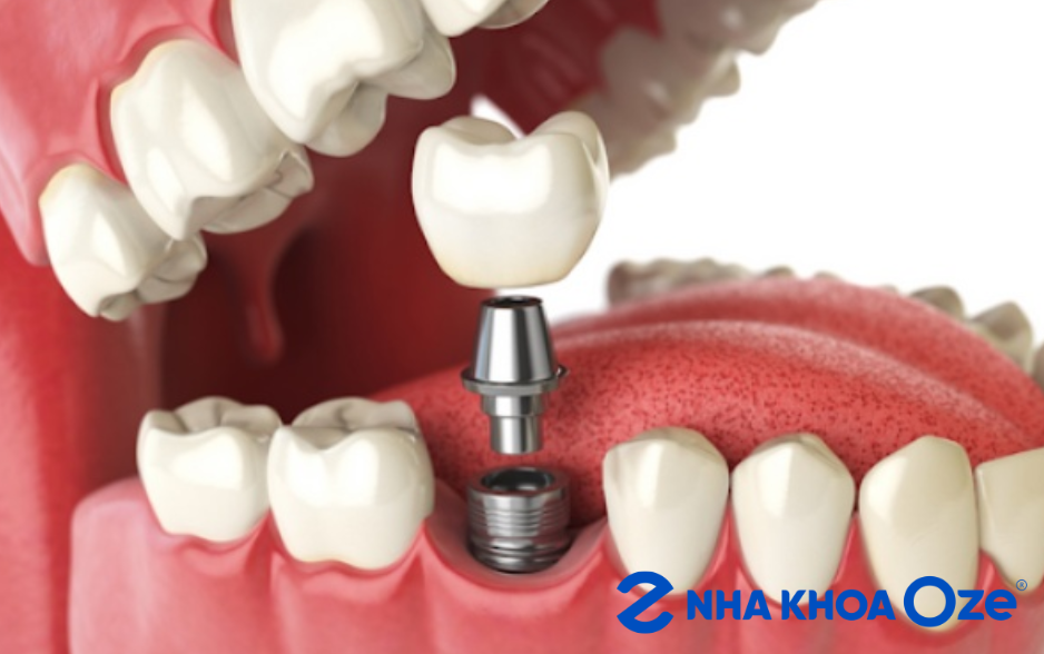 IMPLANT