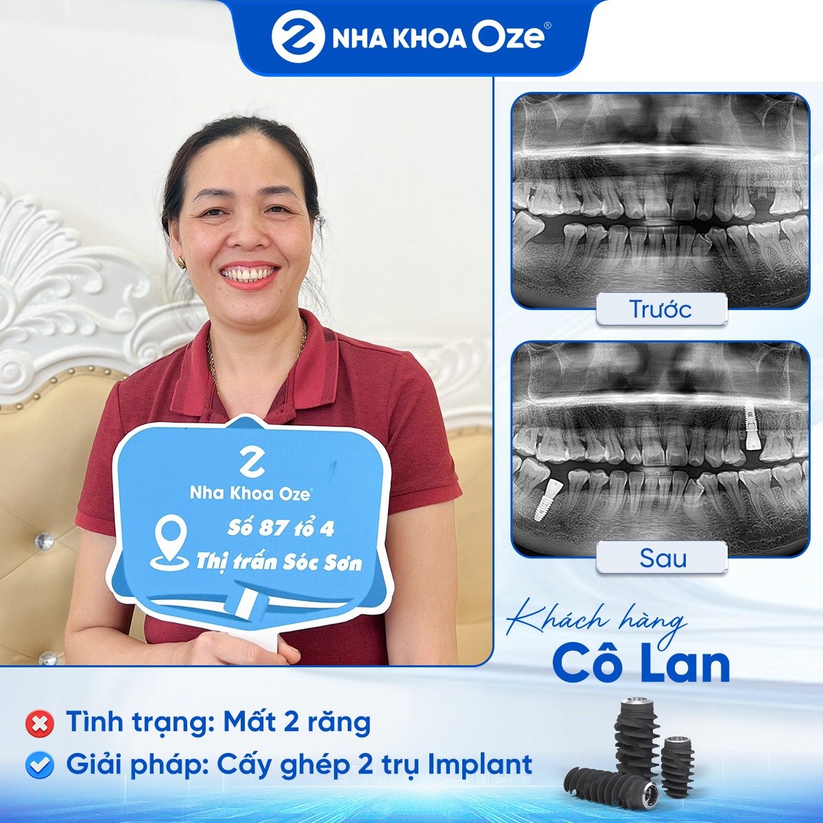 Khách hàng trồng răng implant