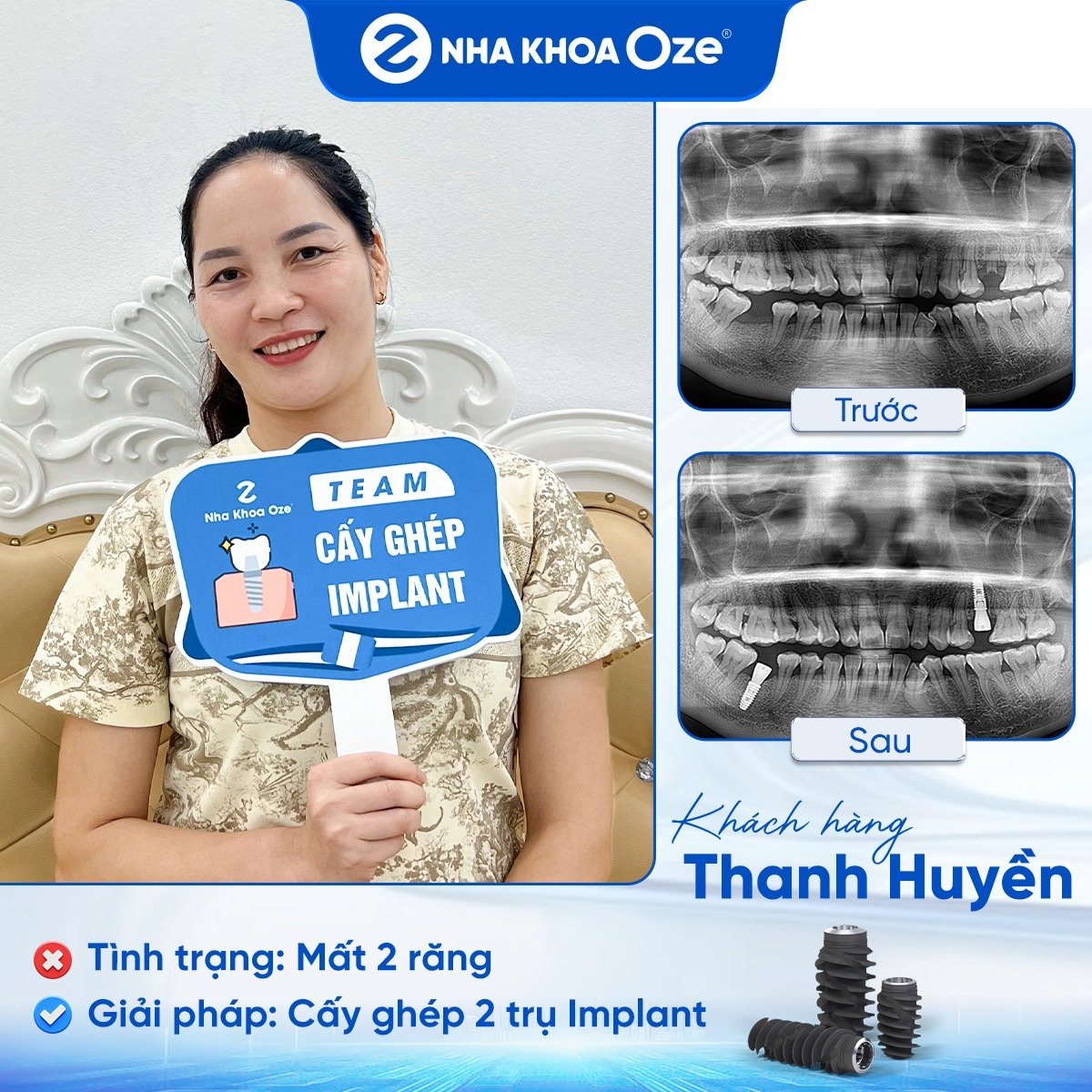 Khách hàng trồng răng implant