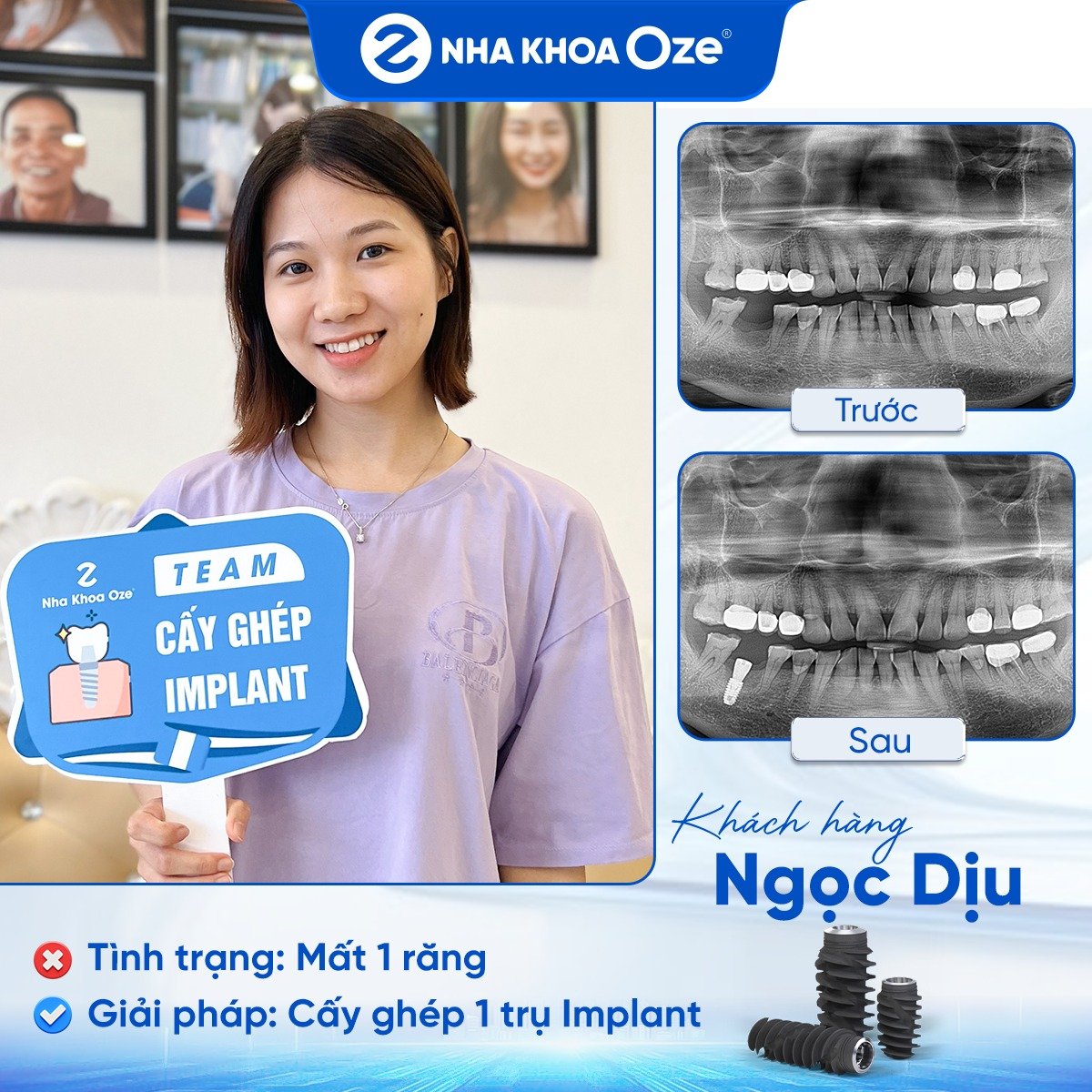 Khách hàng trồng răng implant