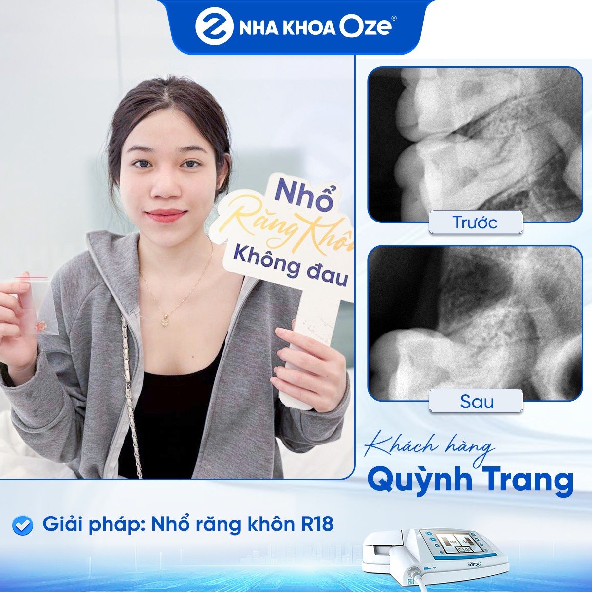 Khách hàng nhổ răng khôn