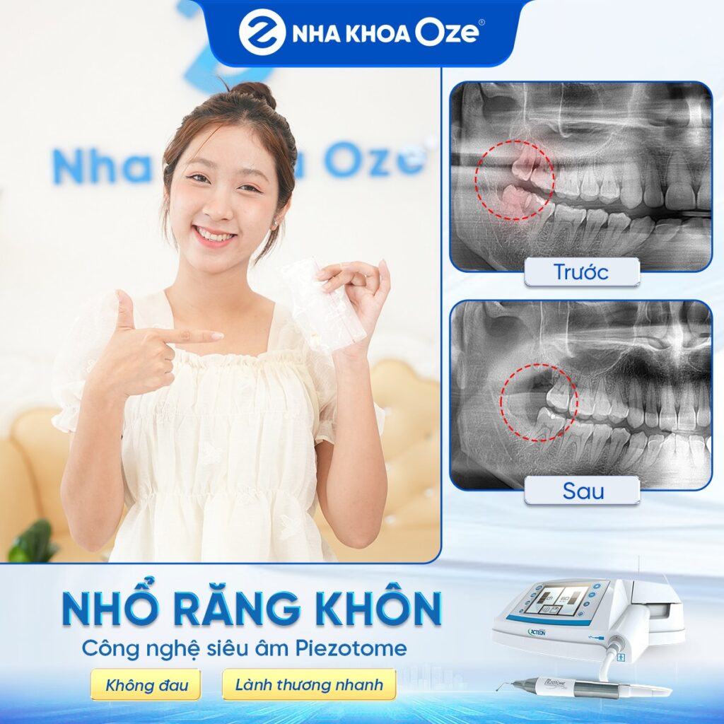 Feedback nhổ răng khôn 6