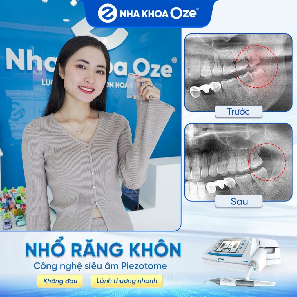 Feedback nhổ răng khôn 8