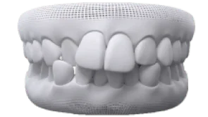 Khớp cắn chéo