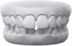 Răng thưa