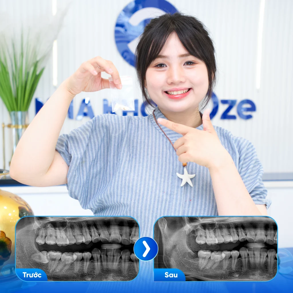 Feedback Nhổ Răng Khôn 1