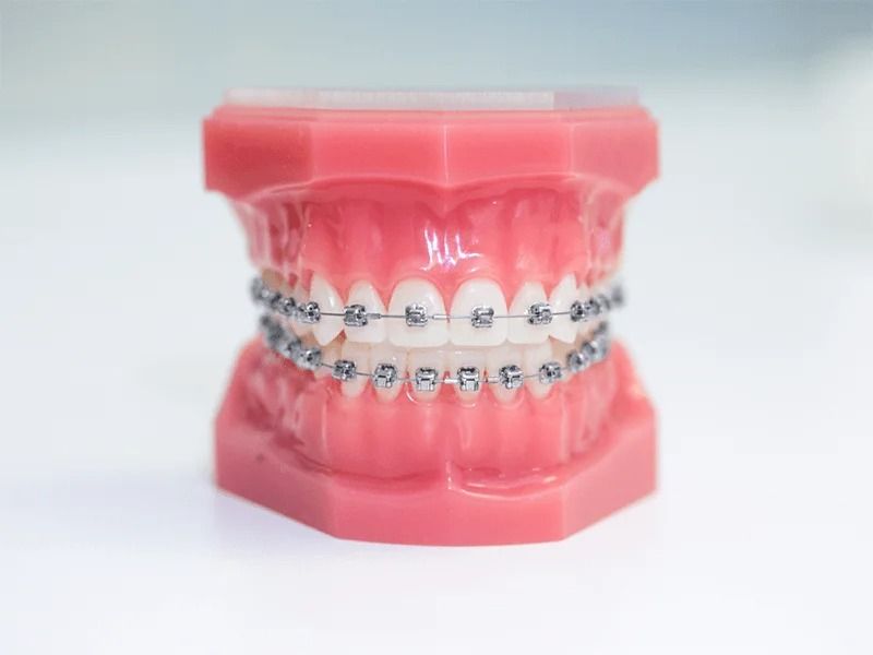 NIỀNG RĂNG MẮC CÀI KIM LOẠI