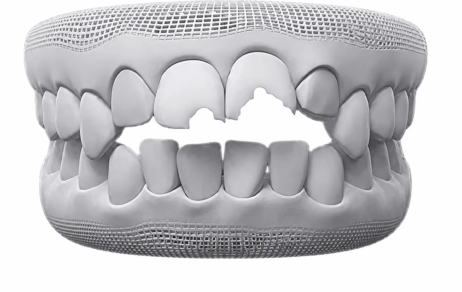 Răng bị sâu, sứt mẻ, gãy vỡ