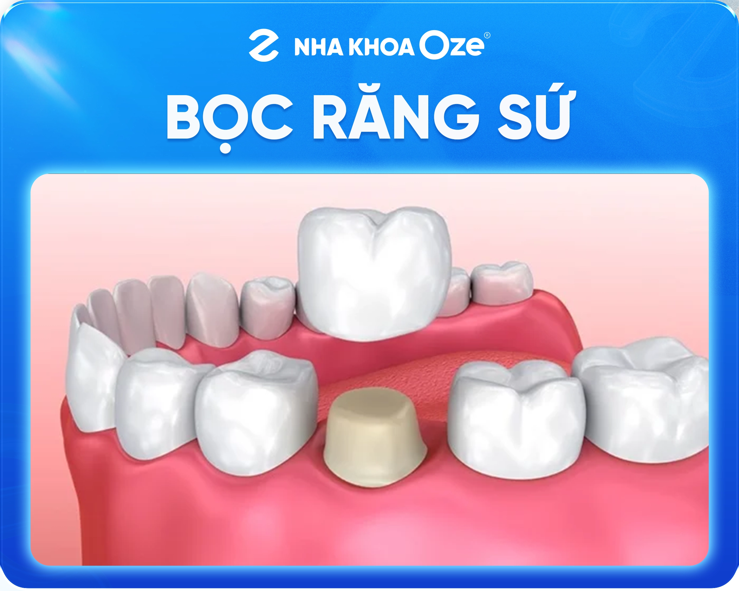 Bọc răng sứ