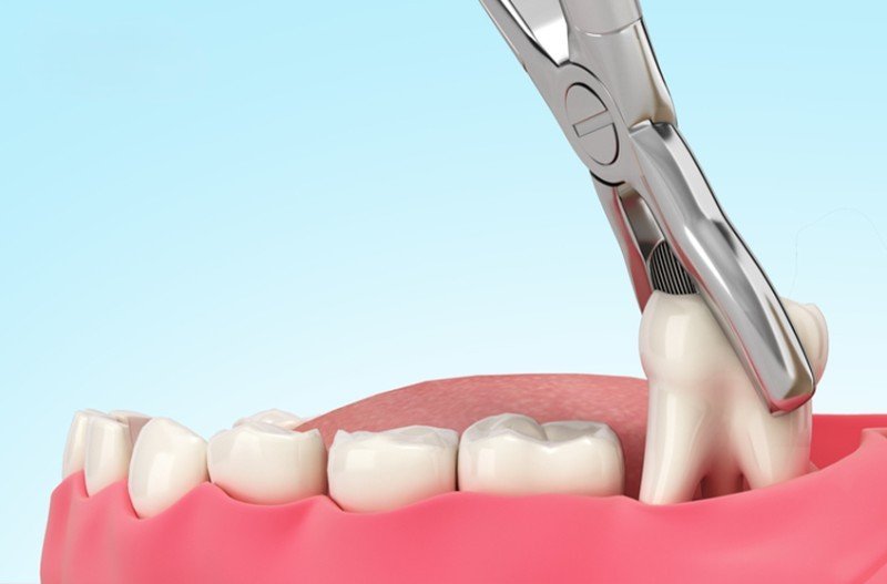 Nhổ răng khôn bằng phương pháp truyền thống