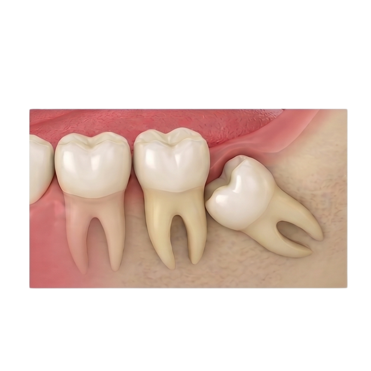 Răng khôn mọc lệch, mọc ngầm