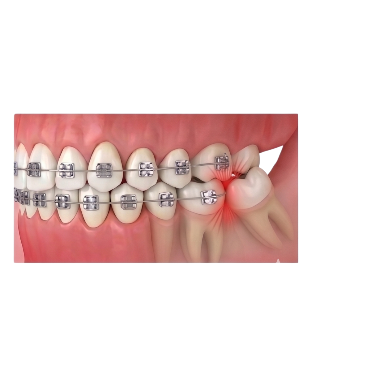 Cản trở chỉnh nha hoặc phục hình