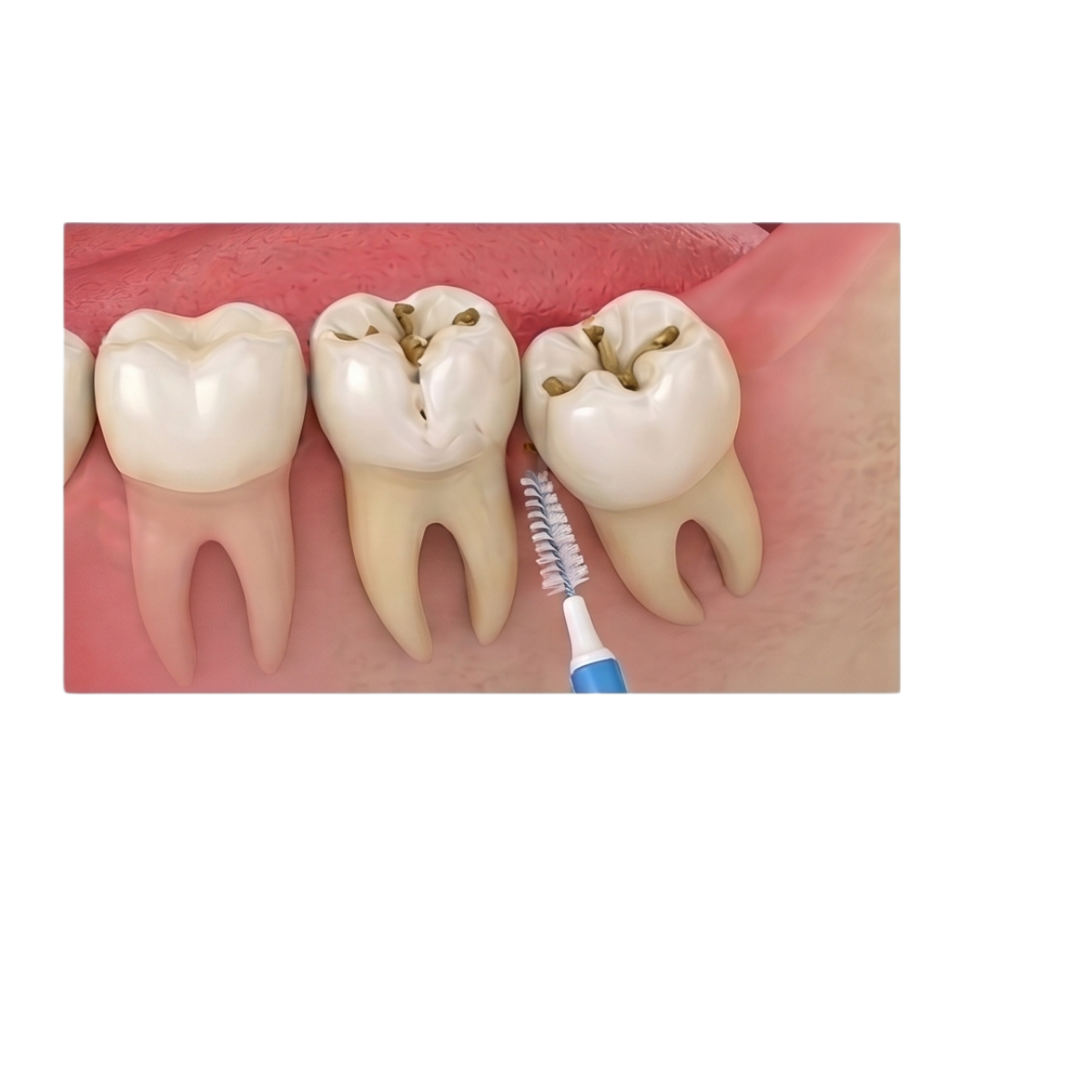 Răng khôn dị dạng, khó vệ sinh