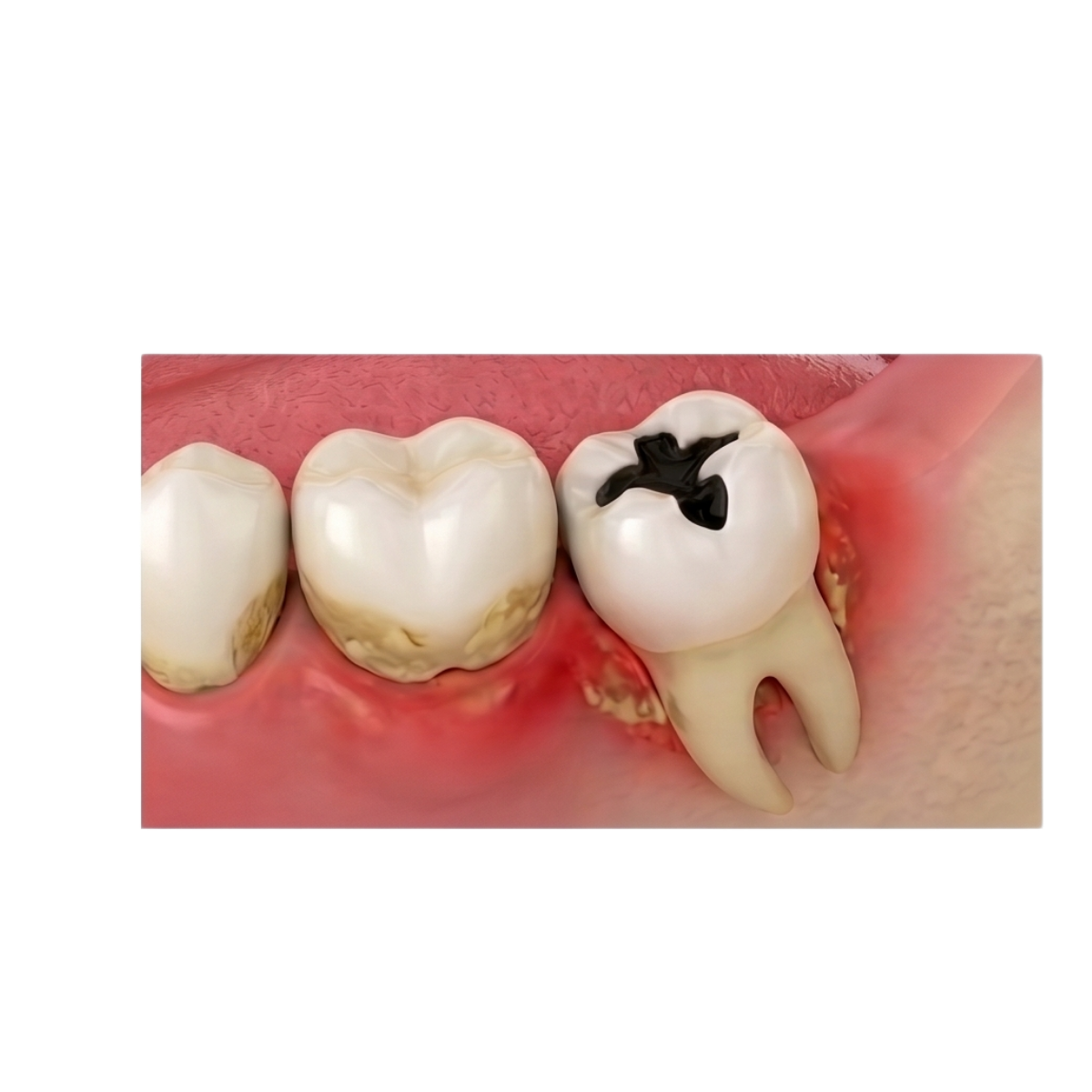 Răng khôn sâu hoặc viêm nha chu